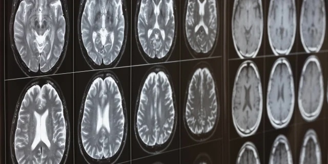 Spotting the Warning Signs of Stroke Critical for Successful Treatment